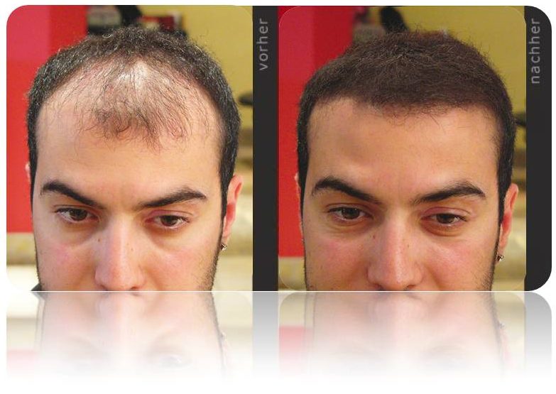 HAIRFOR2 Zahusťovač Vlasů Kompletní Balíček