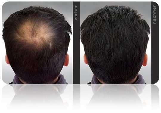 HAIRFOR2 Zahusťovač Vlasů Kompletní Balíček